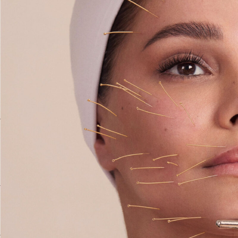acupuncture London at the HVN